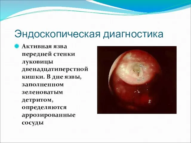 Эндоскопическая диагностика Активная язва передней стенки луковицы двенадцатиперстной кишки. В