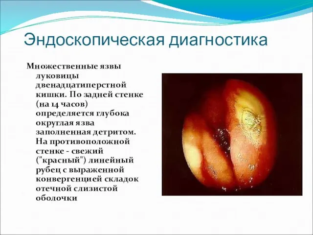 Эндоскопическая диагностика Множественные язвы луковицы двенадцатиперстной кишки. По задней стенке