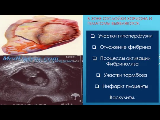 В ЗОНЕ ОТСЛОЙКИ ХОРИОНА И ГЕМАТОМЫ ВЫЯВЛЯЮТСЯ: Участки гипоперфузии Отложение