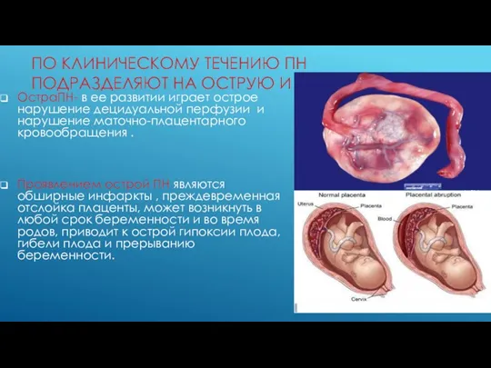 ПО КЛИНИЧЕСКОМУ ТЕЧЕНИЮ ПН ПОДРАЗДЕЛЯЮТ НА ОСТРУЮ И ХРОНИЧЕСКУЮ ОстраПН-