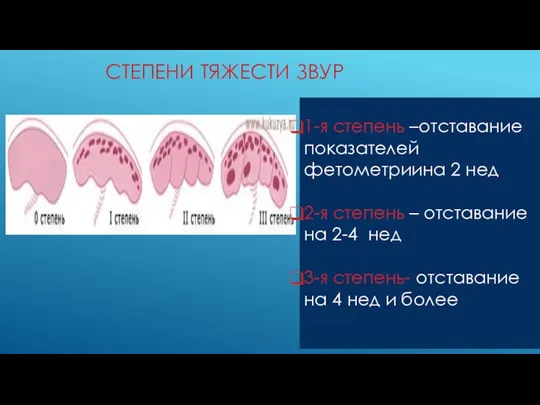 СТЕПЕНИ ТЯЖЕСТИ ЗВУР 1-я степень –отставание показателей фетометриина 2 нед