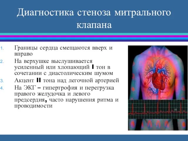 Диагностика стеноза митрального клапана Границы сердца смещаются вверх и вправо