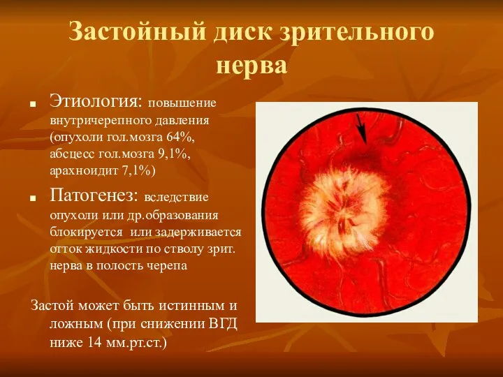 Застойный диск зрительного нерва Этиология: повышение внутричерепного давления (опухоли гол.мозга