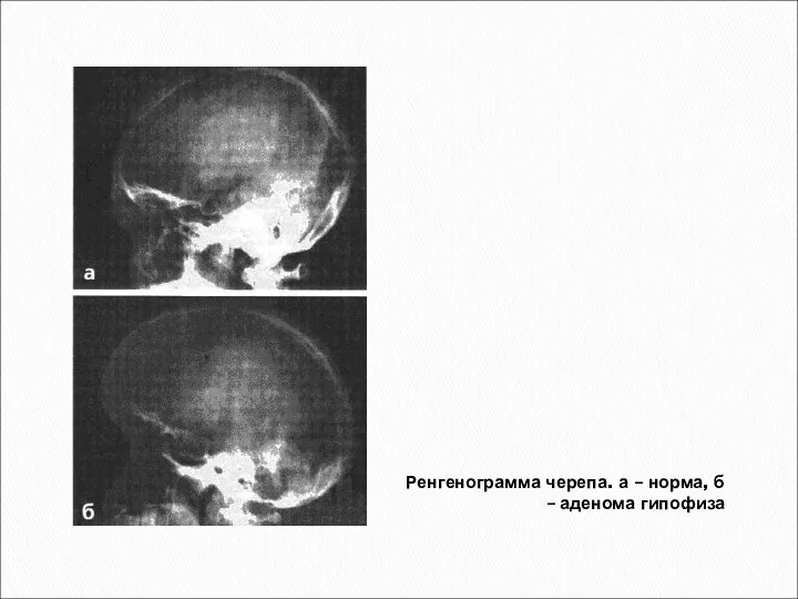 Ренгенограмма черепа. а – норма, б – аденома гипофиза