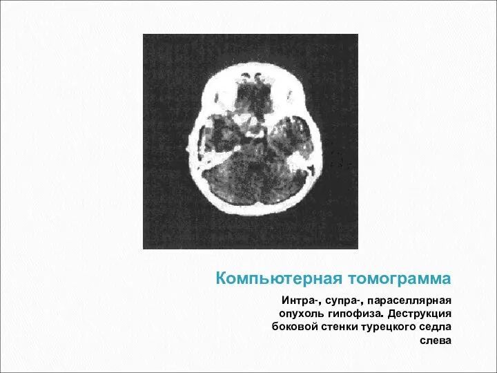 Компьютерная томограмма Интра-, супра-, параселлярная опухоль гипофиза. Деструкция боковой стенки турецкого седла слева