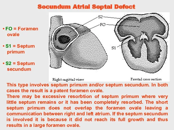 Secundum Atrial Septal Defect This type involves septum primum and/or