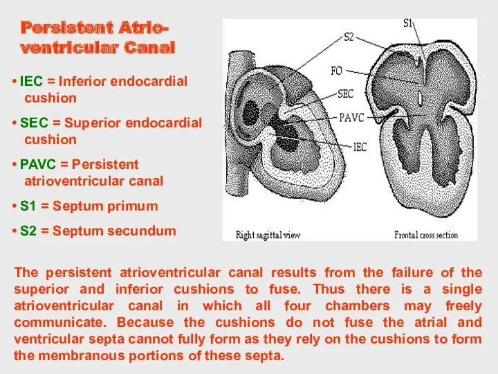 Persistent Atrio- ventricular Canal The persistent atrioventricular canal results from