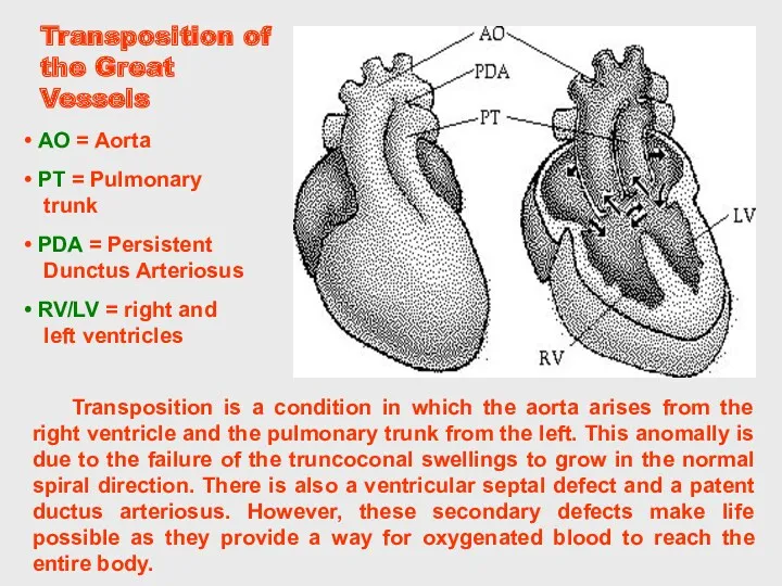 Transposition of the Great Vessels Transposition is a condition in