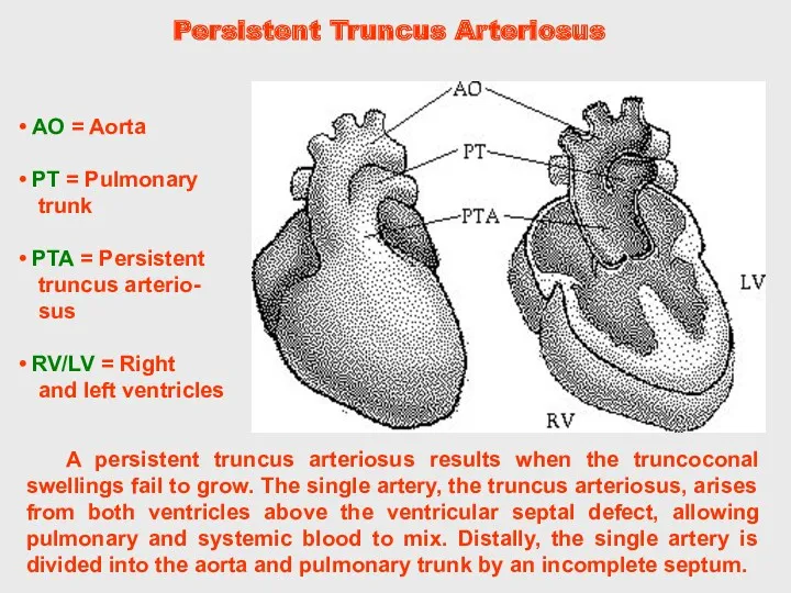 Persistent Truncus Arteriosus A persistent truncus arteriosus results when the