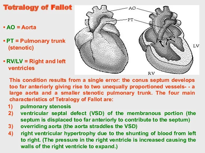 Tetralogy of Fallot right ventricular hypertrophy due to the shunting