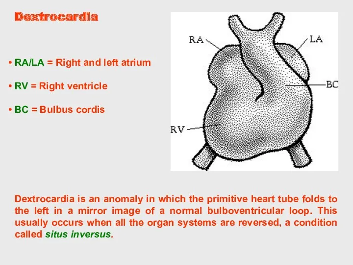 Dextrocardia Dextrocardia is an anomaly in which the primitive heart