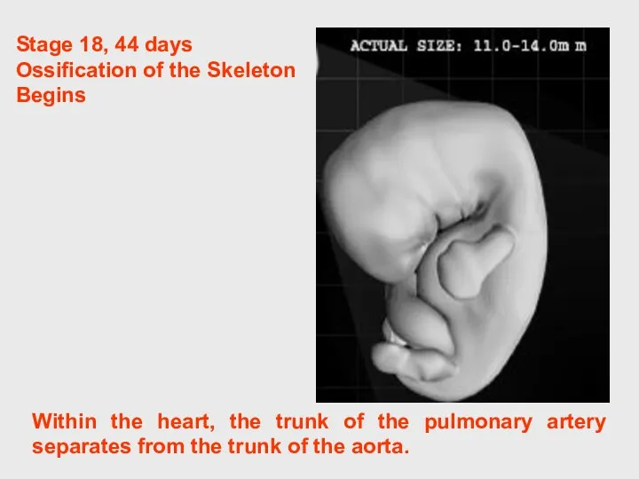 Within the heart, the trunk of the pulmonary artery separates