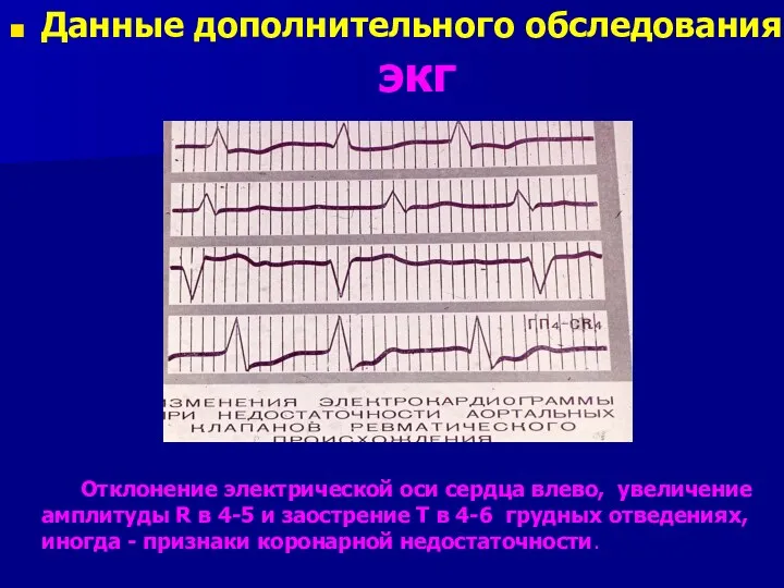 Данные дополнительного обследования. экг Отклонение электрической оси сердца влево, увеличение