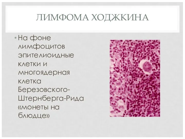 ЛИМФОМА ХОДЖКИНА На фоне лимфоцитов эпителиоидные клетки и многоядерная клетка Березовского-Штернберга-Рида «монеты на блюдце»