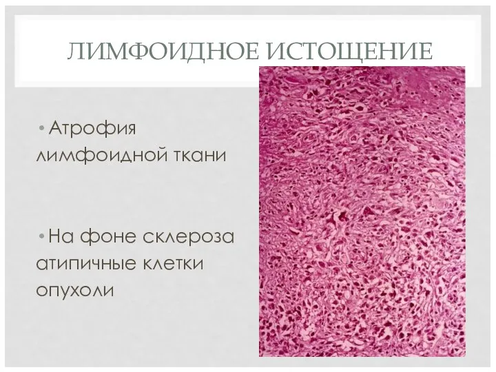 ЛИМФОИДНОЕ ИСТОЩЕНИЕ Атрофия лимфоидной ткани На фоне склероза атипичные клетки опухоли