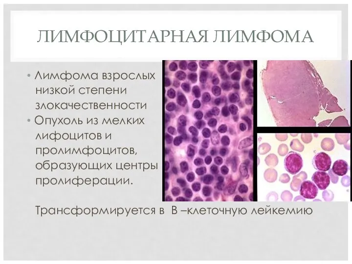 ЛИМФОЦИТАРНАЯ ЛИМФОМА Лимфома взрослых низкой степени злокачественности Опухоль из мелких