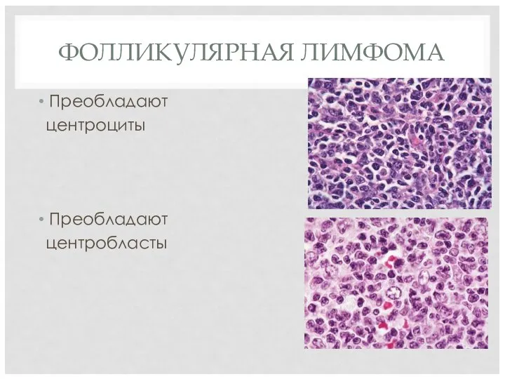 ФОЛЛИКУЛЯРНАЯ ЛИМФОМА Преобладают центроциты Преобладают центробласты