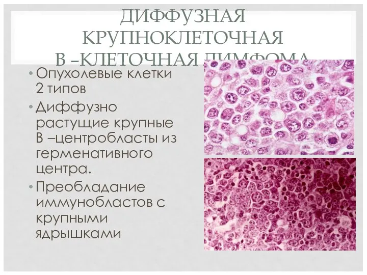 ДИФФУЗНАЯ КРУПНОКЛЕТОЧНАЯ В –КЛЕТОЧНАЯ ЛИМФОМА Опухолевые клетки 2 типов Диффузно