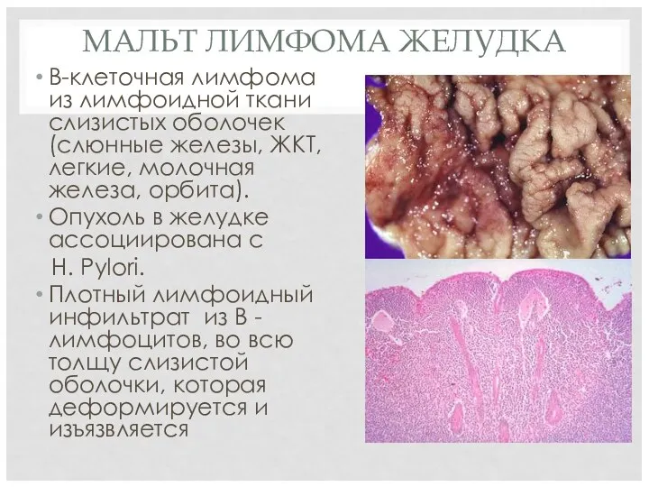 МАЛЬТ ЛИМФОМА ЖЕЛУДКА В-клеточная лимфома из лимфоидной ткани слизистых оболочек