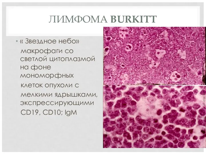 ЛИМФОМА BURKITT « Звездное небо» макрофаги со светлой цитоплазмой на