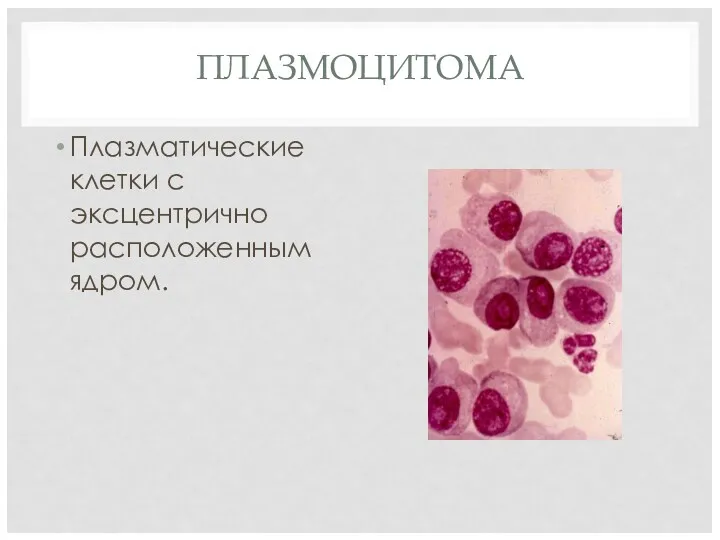 ПЛАЗМОЦИТОМА Плазматические клетки с эксцентрично расположенным ядром.