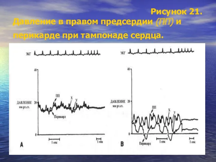 Рисунок 21. Давление в правом предсердии (ПП) и перикарде при тампонаде сердца.