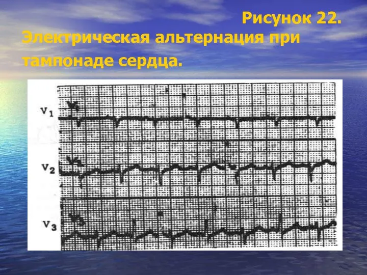 Рисунок 22. Электрическая альтернация при тампонаде сердца.