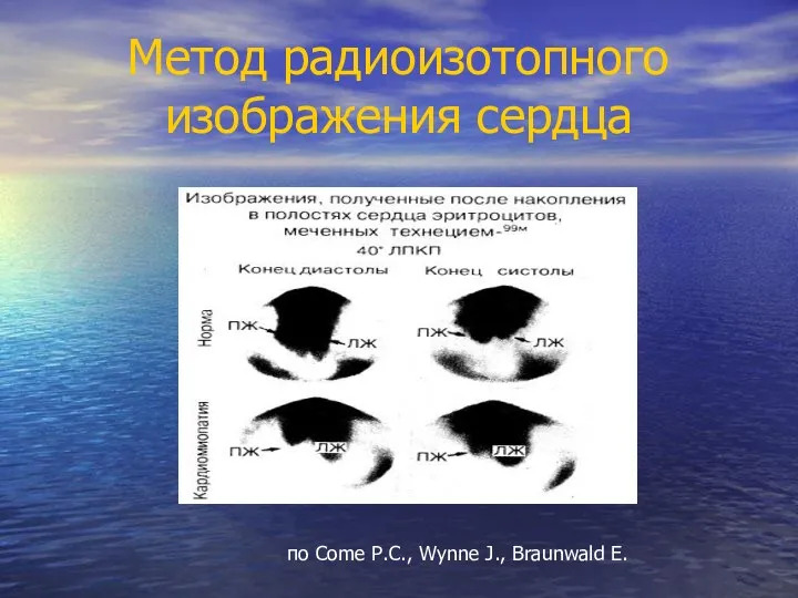 Метод радиоизотопного изображения сердца по Come P.C., Wynne J., Braunwald E.