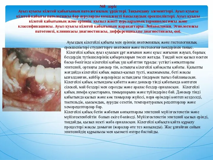 №8 дәріс Ауыз қуысы кілегей қабығының патологиялық үрдістері. Зақымдану элементтері. Ауыз қуысы кілегей