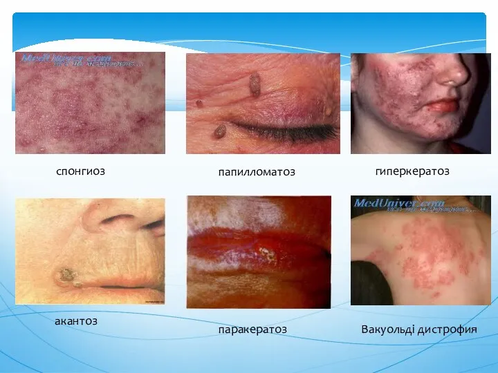 спонгиоз акантоз папилломатоз Вакуольді дистрофия гиперкератоз паракератоз
