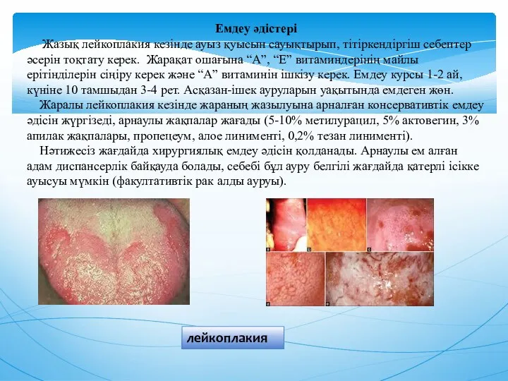 Емдеу әдiстерi Жазық лейкоплакия кезiнде ауыз қуысын сауықтырып, тiтiркендiргiш себептер