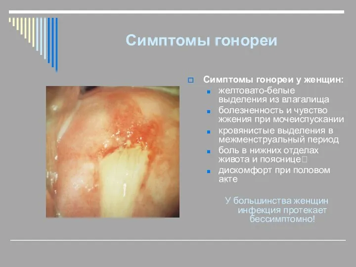 Симптомы гонореи Симптомы гонореи у женщин: желтовато-белые выделения из влагалища