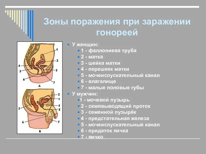 Зоны поражения при заражении гонореей У женщин: 1 - фаллопиева