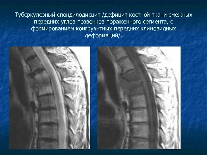 Туберкулезный спондилодисцит /дефицит костной ткани смежных передних углов позвонков пораженного