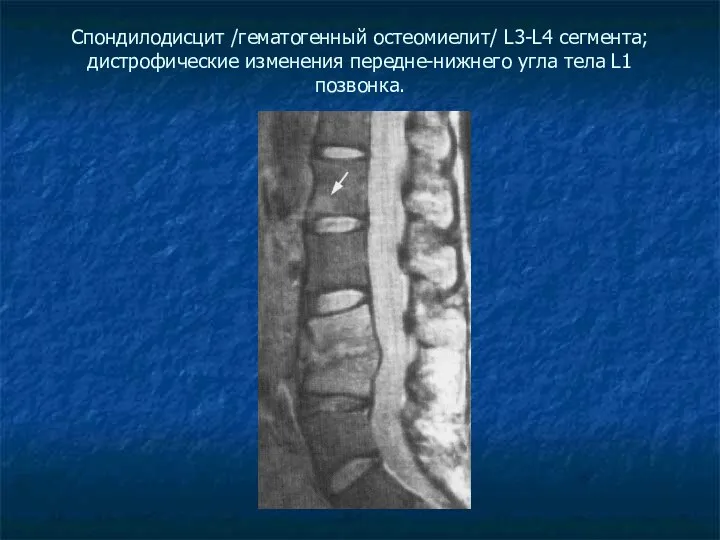 Спондилодисцит /гематогенный остеомиелит/ L3-L4 сегмента; дистрофические изменения передне-нижнего угла тела L1 позвонка.