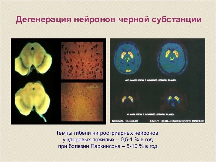 Дегенерация нейронов черной субстанции Темпы гибели нигростриарных нейронов у здоровых