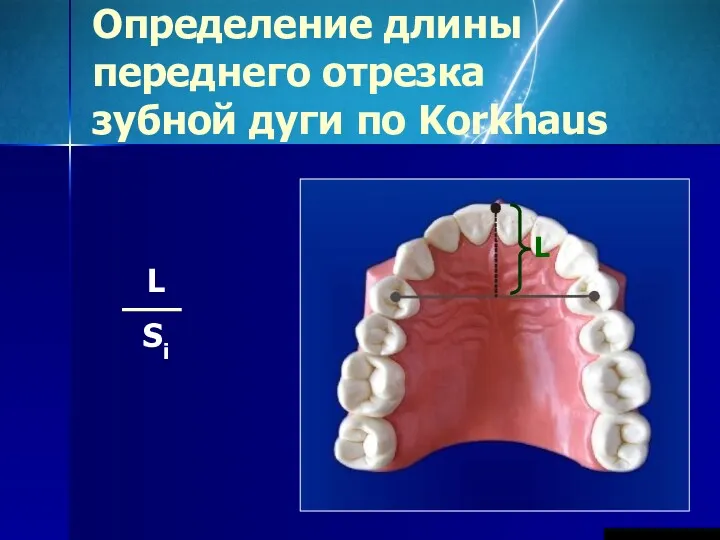 Определение длины переднего отрезка зубной дуги по Korkhaus L