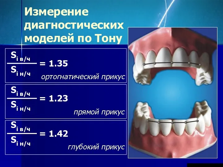 Измерение диагностических моделей по Тону ортогнатический прикус прямой прикус глубокий прикус