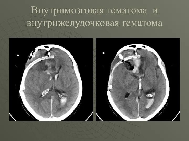 Внутримозговая гематома и внутрижелудочковая гематома