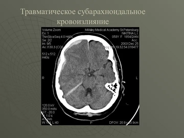 Травматическое субарахноидальное кровоизлияние