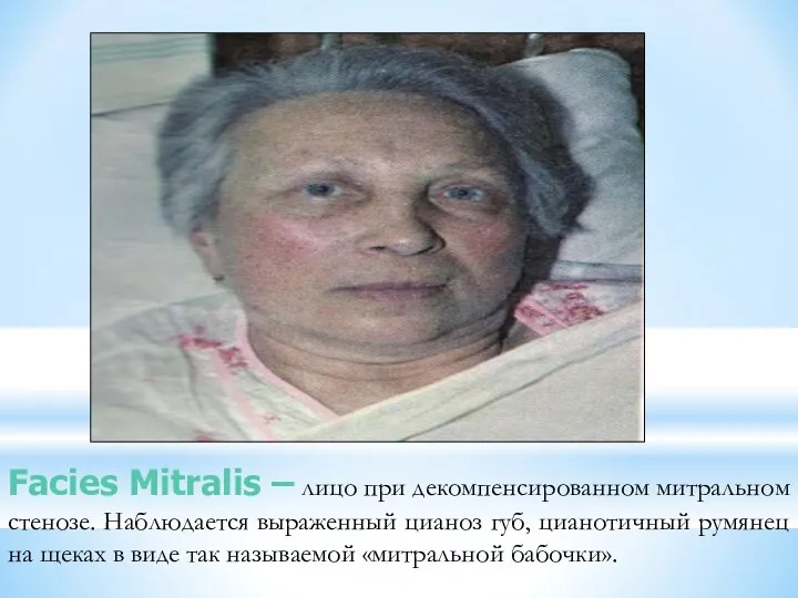 Facies Mitralis – лицо при декомпенсированном митральном стенозе. Наблюдается выраженный цианоз губ, цианотичный
