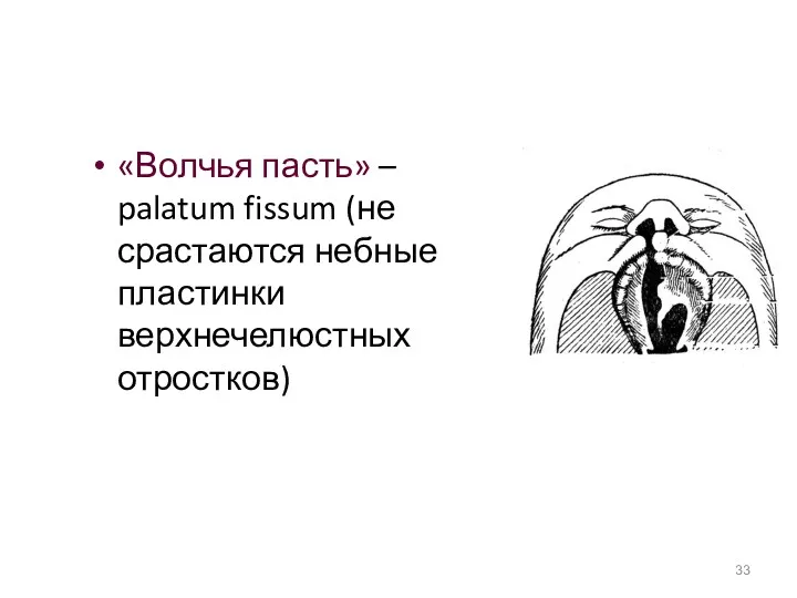 «Волчья пасть» – palatum fissum (не срастаются небные пластинки верхнечелюстных отростков)