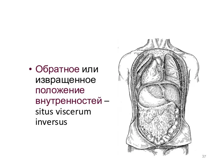 Обратное или извращенное положение внутренностей – situs viscerum inversus