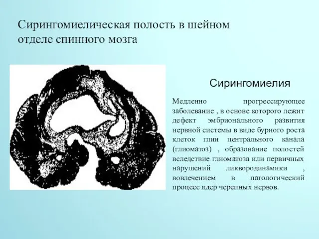 Сирингомиелия Медленно прогрессирующее заболевание , в основе которого лежит дефект эмбрионального развития нервной