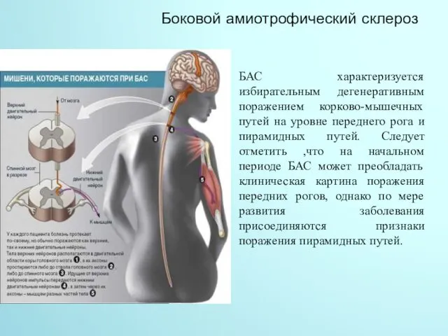 Боковой амиотрофический склероз БАС характеризуется избирательным дегенеративным поражением корково-мышечных путей на уровне переднего