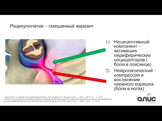 Радикулопатия – смешанный вариант Ноцицептивный компонент –активация периферических ноцицепторов (