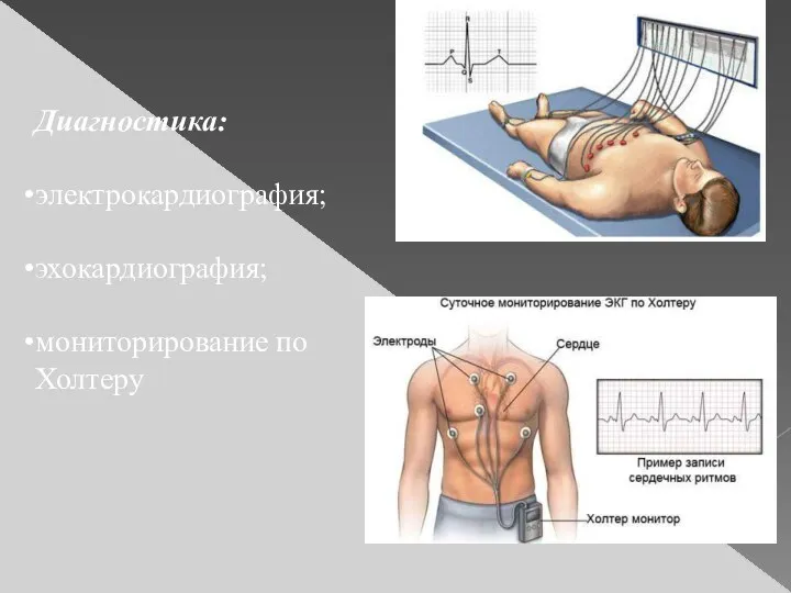 Диагностика: электрокардиография; эхокардиография; мониторирование по Холтеру