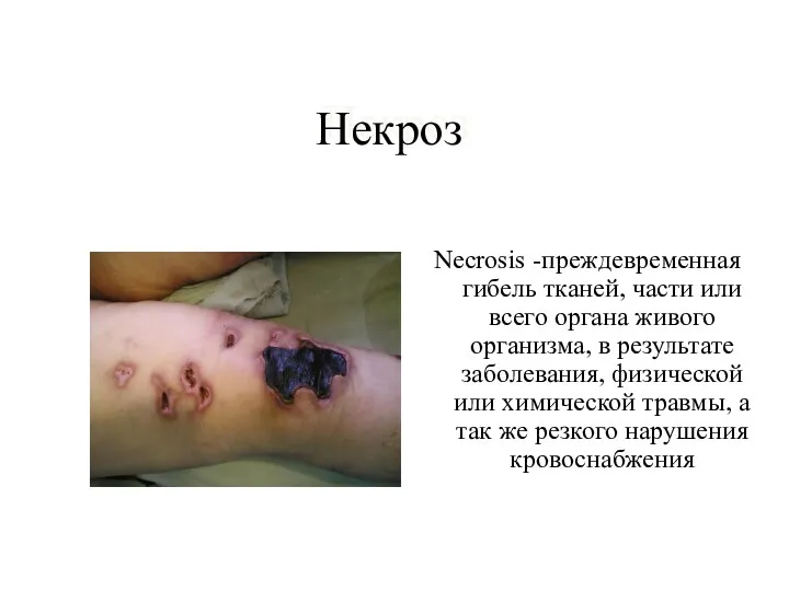Некроз Necrosis -преждевременная гибель тканей, части или всего органа живого организма, в результате