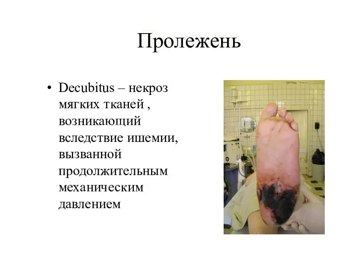 Пролежень Decubitus – некроз мягких тканей , возникающий вследствие ишемии, вызванной продолжительным механическим давлением