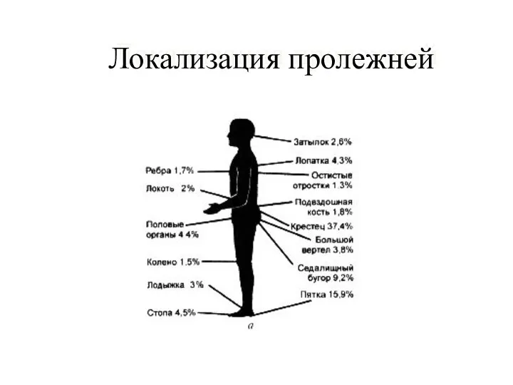 Локализация пролежней